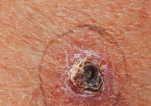 What are the best ways to prevent skin cancer in men?